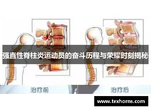 强直性脊柱炎运动员的奋斗历程与荣耀时刻揭秘